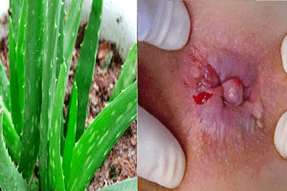 Aloe zur Behandlung von Hämorrhoiden