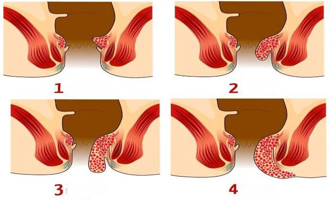 wie Hämorrhoiden in verschiedenen Stadien auftreten